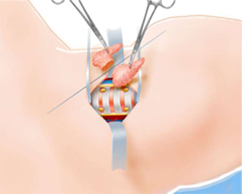 Thyroid Screening